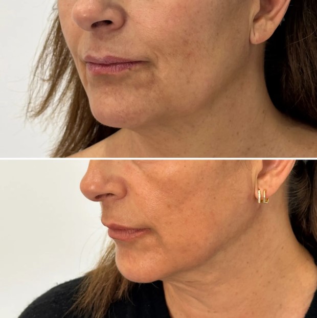 antes y despues FACETITE